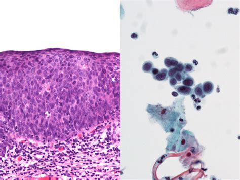 Cervix Severe Dysplasia Histologycytology Correlation Of Flickr