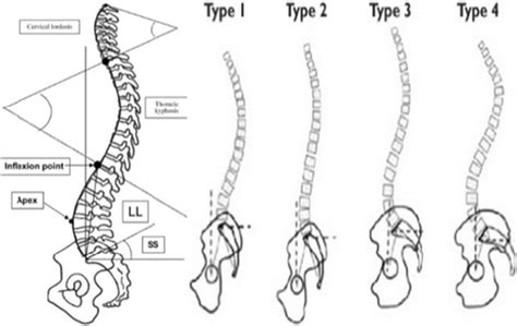Subdivision Of The Sagittal Spinal Curvatures According To The