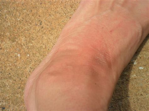 My Skin Is Dry And Scaly On Tops Of Feet And Turning Dark Colored