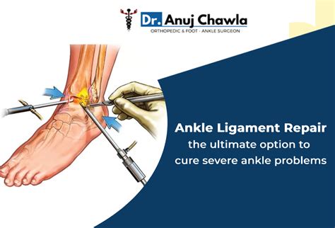 Ankle Ligament Repair The Ultimate Option To Cure Severe Ankle Problems