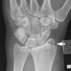 Wrist Radiology Key