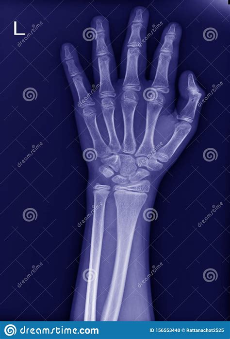 X Ray Left Wrist No Fracture And Normal Joint Stock Photo