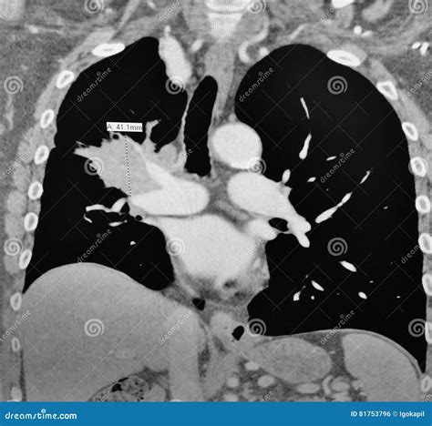Computer Tomography Right Mediastinal Lymphoma Stock Photo Image Of