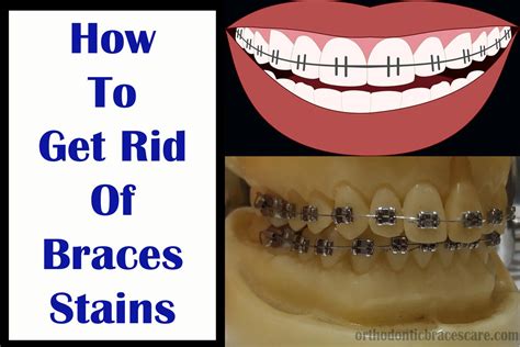 Braces Stains How To Remove Causes Prevention Orthodontic Braces Care