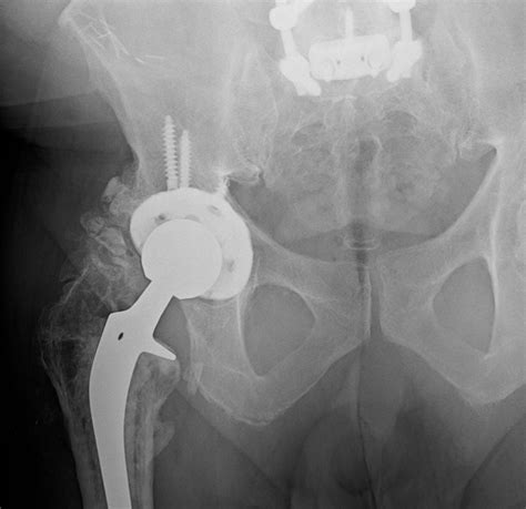 Orthodx Hip Tightness Following Total Hip Replacement Clinical Advisor
