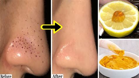 How To Remove Blackheads And Whiteheads From Nose And Face Naturally At