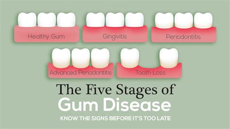 the five stages of gum disease — the mckenzie center implants and periodontics