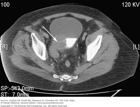 What Does Bladder Cancer Look Like On Ct Scan Updated