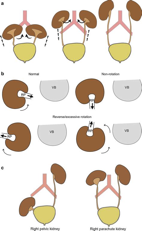 Embryology Of Renal Ascent And Rotation A Bilateral Renal Masses Form