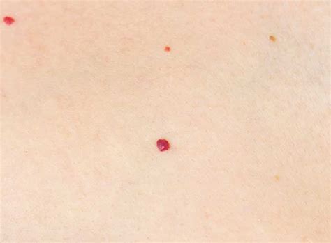 Cherry Angioma On Face Angiomas American Osteopathic College Of