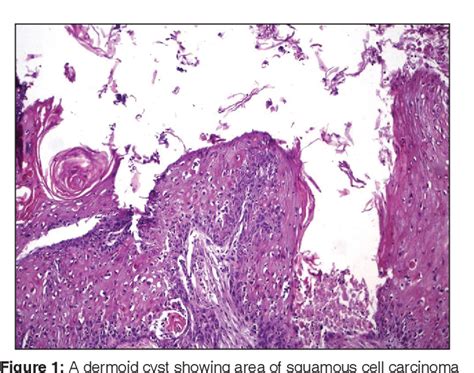 Figure 1 From Squamous Cell Carcinoma Arising In Mature Cystic Teratoma