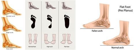 The Treatment And Cause For Adult Aquired Flat Foot Gayla Chiphe