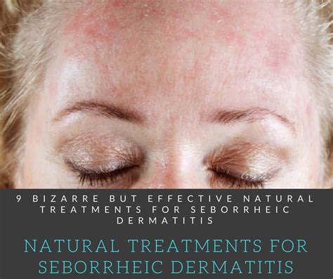 Seborrheic Dermatitis Nose Treatment Javsystema