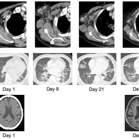 Chest And Brain Imaging A Right Axillary Lymphadenopathy Gradually