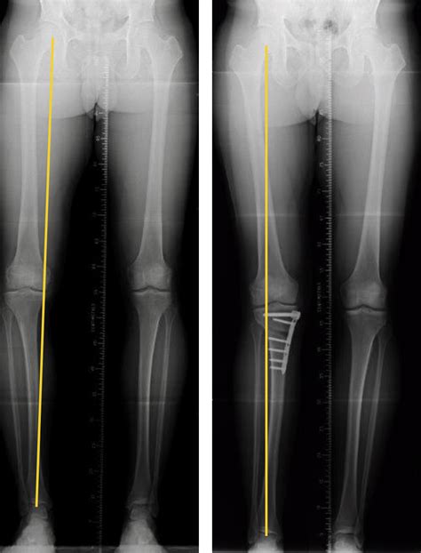Osteotomy Knee Specialists