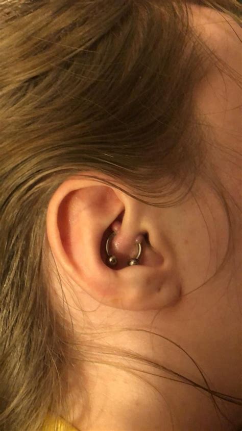 Infected Ear Lobe Piercing Bump