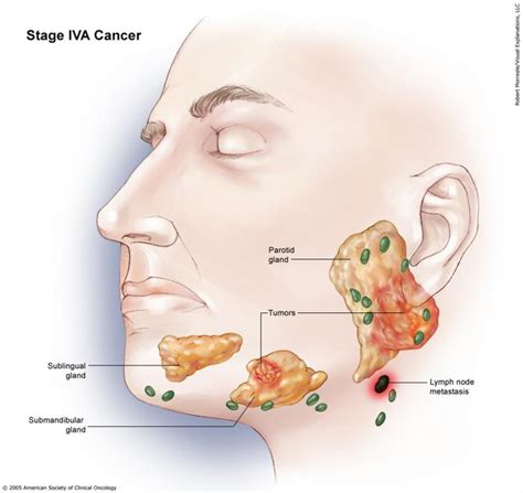 Such benign masses include cysts, inflamed lymph nodes, and lipomas and as such are not listed below. Salivary Gland Cancer: Stages and Grades | Cancer.Net