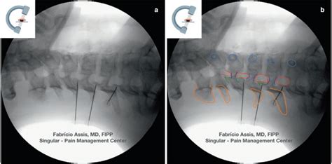 Cervical Medial Branch Block And Radiofrequency Ablation Oblique