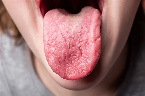 Tongue Disease Health Clues Hiding On Your Tongue Readers Digest