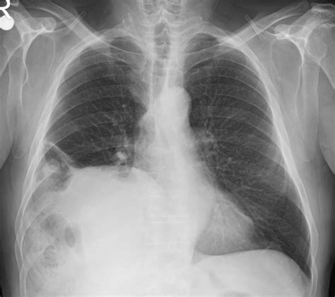 Chest X Ray Showing An Elevated Right Diaphragm Download Scientific