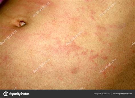 Pink Lichen On The Skin Of The Abdomen Psoriasis Dermatitis Eczema