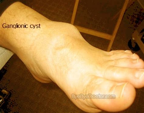 Ganglion Cyst Foot Pictures Symptoms Surgery Treatment Removal