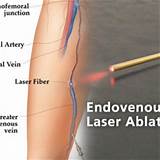 Endovenous Laser Treatment Pictures
