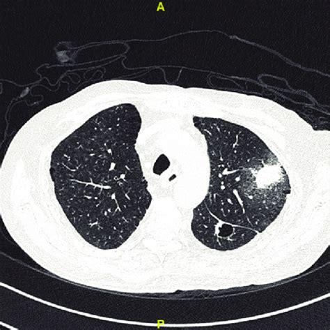 Noncontrast Computed Tomography Chest Of An Adult Male With Aspergillus