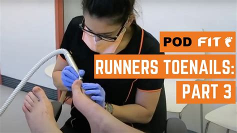 Runners Toenails 3 Podiatry Treatment Youtube