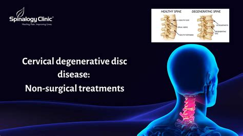 Cervical Degenerative Disc Disease Spinalogy Blogs Best Back Pain