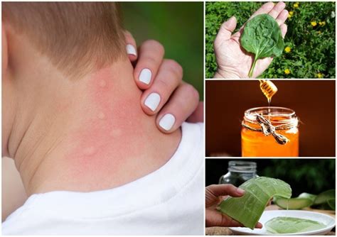 How To Get Rid Of Mosquito Bites 15 Home Remedies For Instant Relief