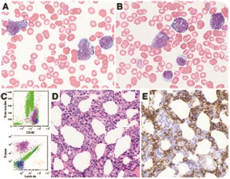 Leukemic Presentation Of Diffuse Large B Cell Lymphoma An Unusual