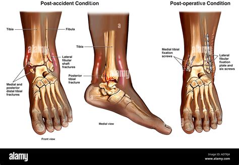 Las Fracturas De Tobillo Trimalleolar Del Tobillo Izquierdo Con