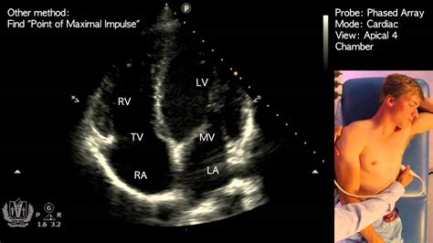 Apical 4 Chamber View On Transthoracic Echocardiography Cardiac