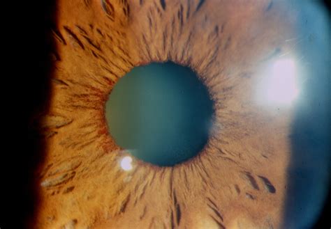 Neovascular Glaucoma Intechopen
