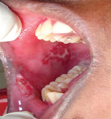 Common Oral Lesions Buccal Mucosa
