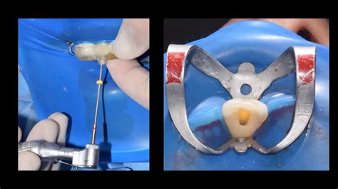 Guided Endodontic Access For Root Canal Treatment For Calcified