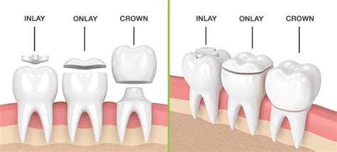 Dental Crowns Everything You Need To Know Vc Dental