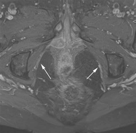 Axial Mri T1 Fs C In A 57 Year Old Woman Presenting With Pudendal