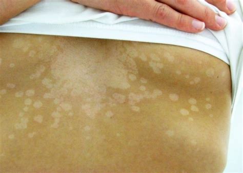 Tinea Versicolor White Spots On Neck Shoulders Key To Perfect Health