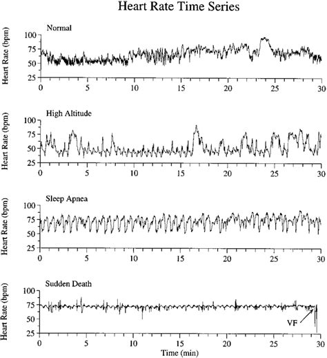 What is a normal heart rate varies from person to person. Representative complex physiological fluctuations. Heart ...