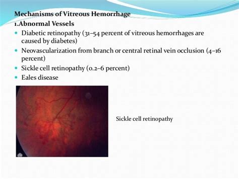 Vitreous Hemorrhage Treatment Tips Captions Trend