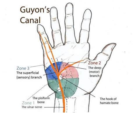 Sindromul De Canal Guyon Clinica Cosmedica