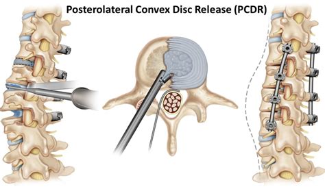 Posterior Spinal Fusion With Multilevel Posterolateral Convex Disc