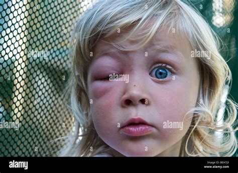 Bee Sting Face Hi Res Stock Photography And Images Alamy
