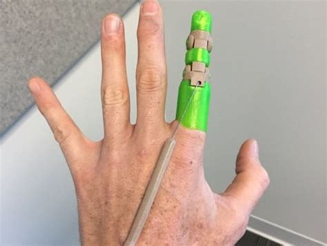 Introducing The Knick Finger D Printed Partial Finger Replacement Device Prosthetic