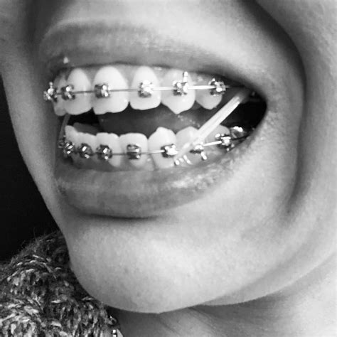 Oral anesthetics a simple way to get some braces pain relief is to rub an oral anesthetic like orajel or anbesol directly on the sensitive teeth and gums. Finally time for elastics! In pain 😩 : braces