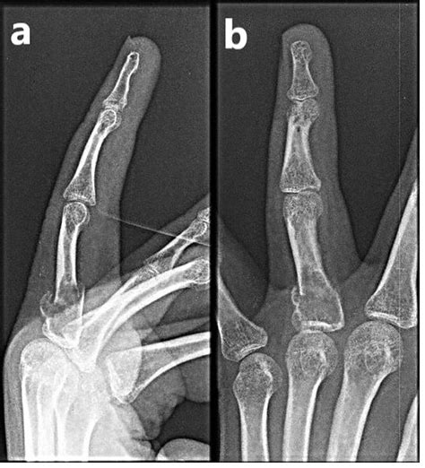 cureus an unusual case of finger fracture