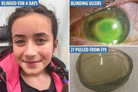 Contact Lens Horror Stories Including Pus Filled Sockets Weeping Eye
