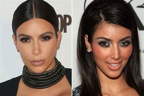 Kim Kardashian Plastic Surgery Journey Before And After 2023